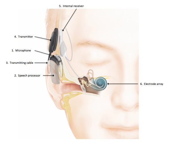 te ontvangen mate Vooruitzien Cochlear Implants - Westchester Hearing Center